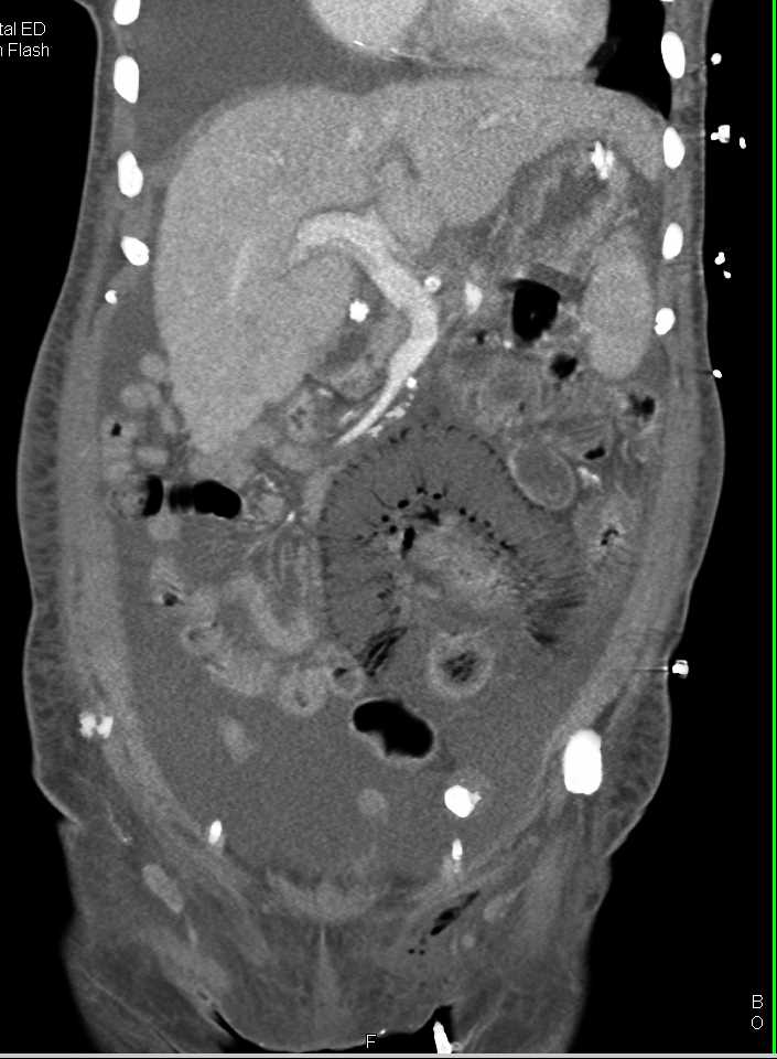 Ischemic Bowel with Air in Small Bowel Wall and in Portal Venous System - CTisus CT Scan