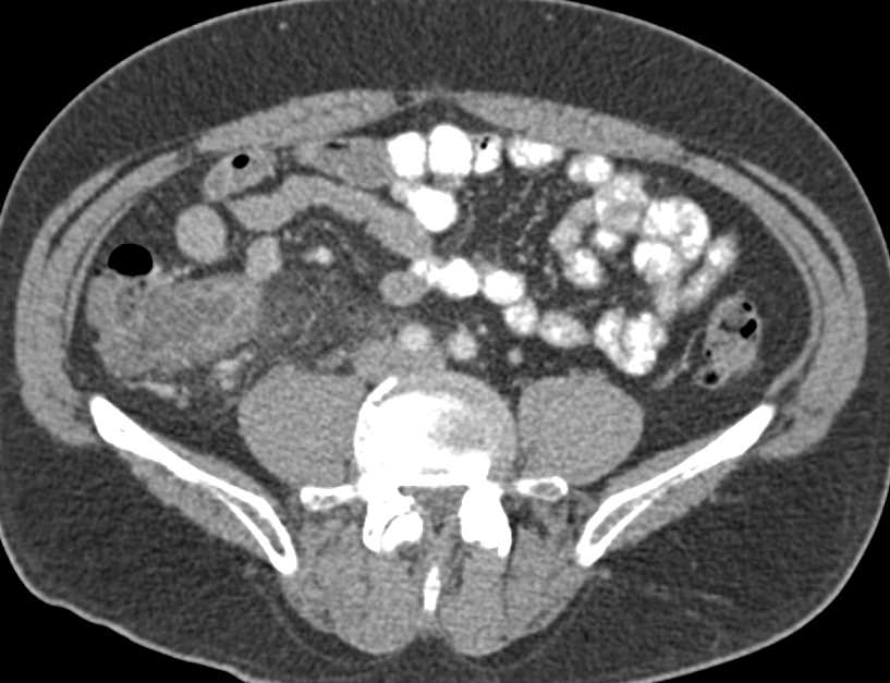 Crohn's Disease with Right Lower Quadrant Phlegmon - CTisus CT Scan