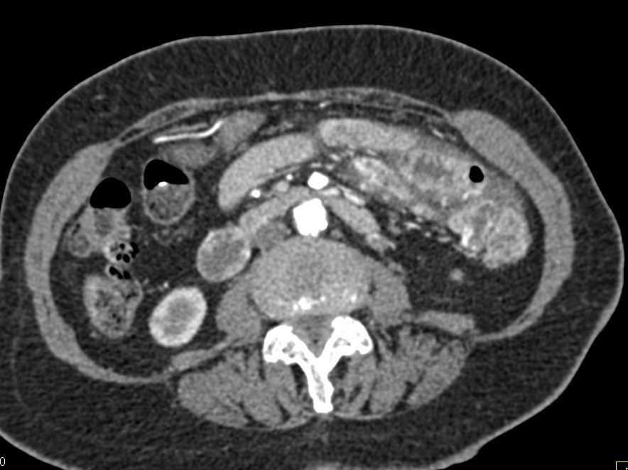 Inflamed Jejunal Loops due to Infectious Enteritis - CTisus CT Scan