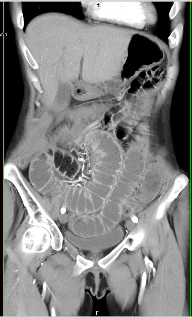 SBO (Small Bowel Obstruction) due to Adhesions - CTisus CT Scan