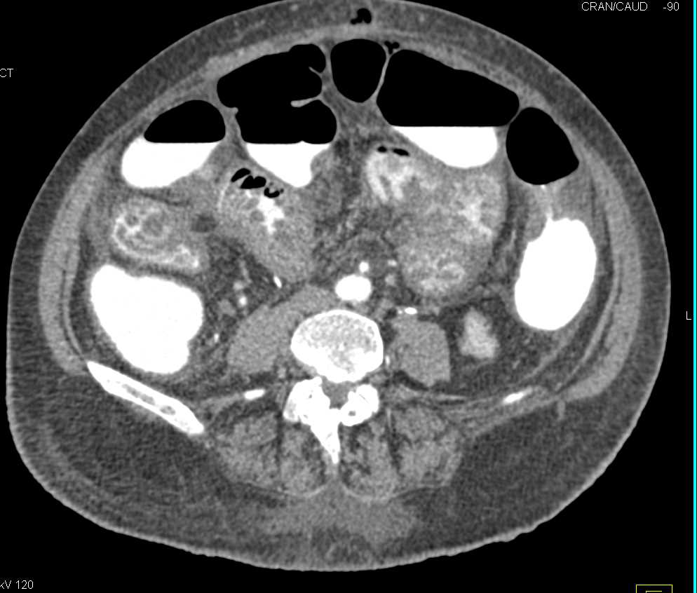 Infectious Enteritis Small Bowel - CTisus CT Scan