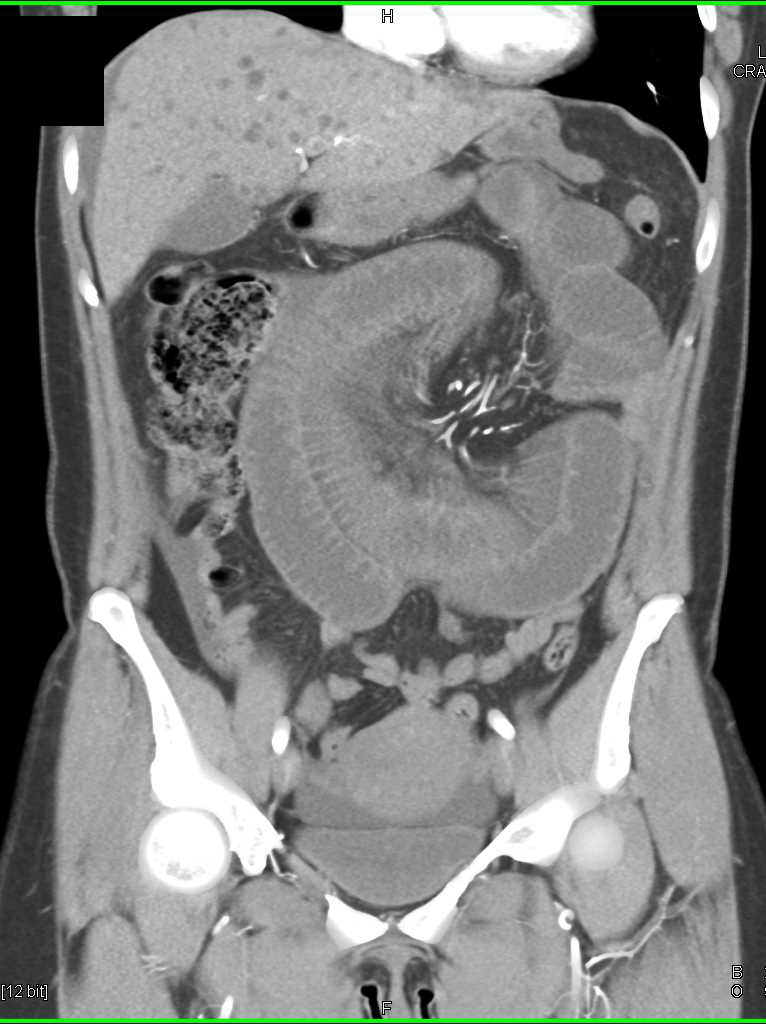 Small Bowel Volvulus with Ischemic Bowel - CTisus CT Scan