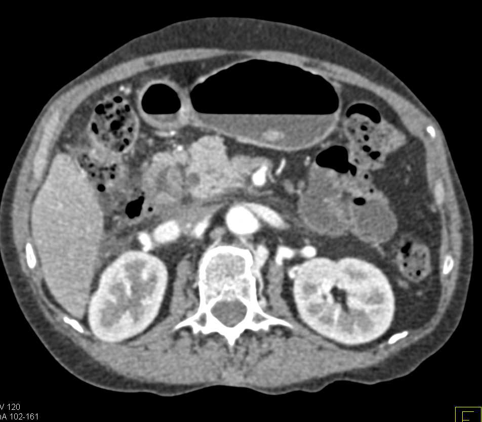 Duodenal Perforation Following Endoscopy with Fluid and Extraluminal Air - CTisus CT Scan