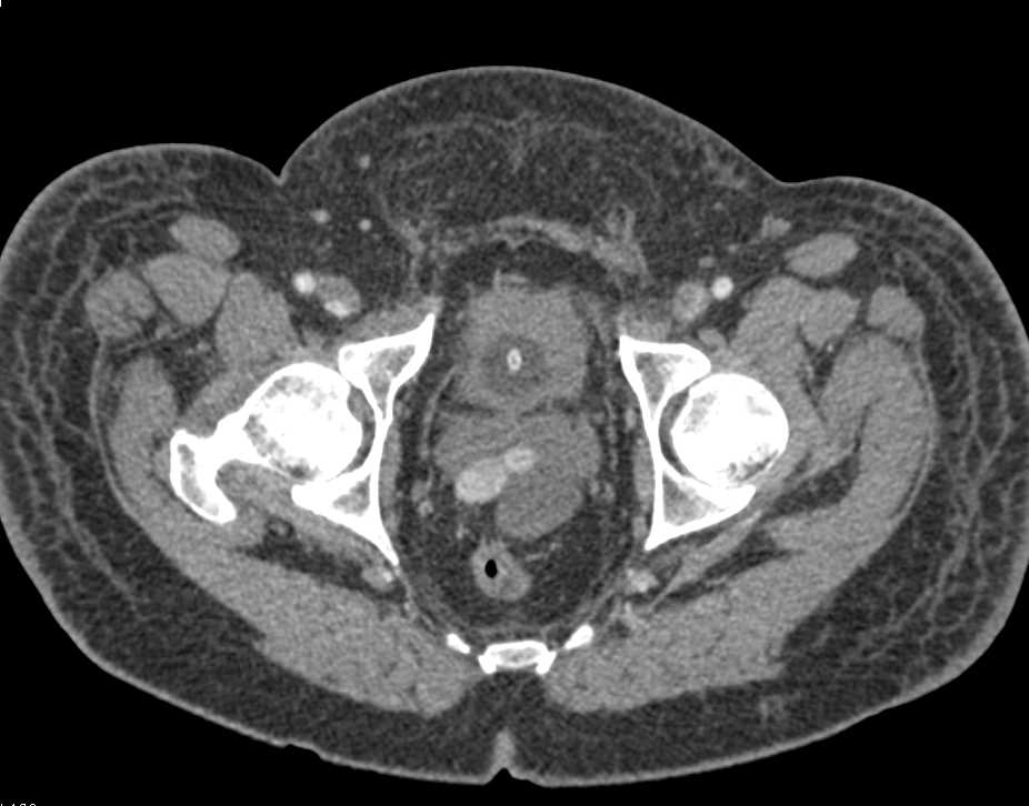 Post Op Small Bowel Partial Obstruction - CTisus CT Scan