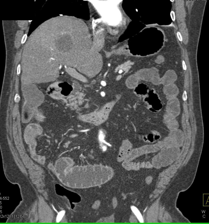 Small Bowel Obstruction (SBO) due to stricture due to Crohn's Disease - CTisus CT Scan