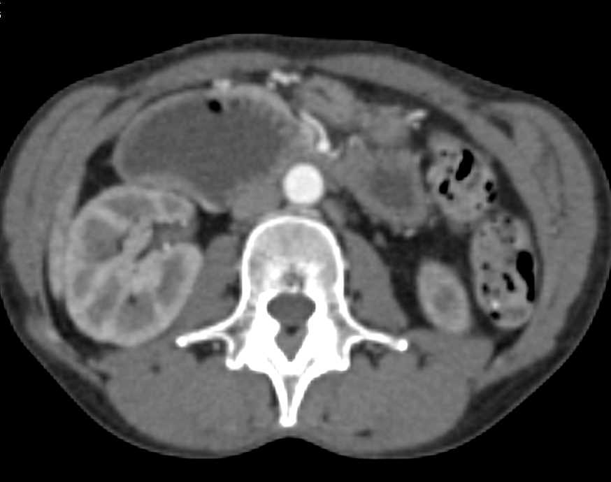 Superior Mesenteric Artery (SMA) Syndrome with Narrowed SMA Angle and Dilated Proximal Duodenum - CTisus CT Scan
