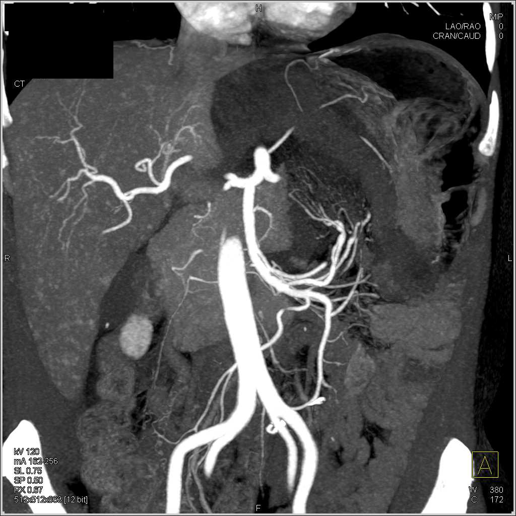 Internal Hernia with Midgut Volvulus with Small Bowel Obstruction and Ischemic Bowel - CTisus CT Scan