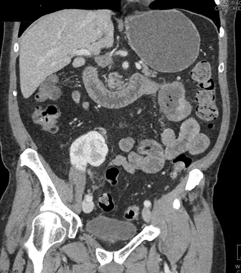 Carcinoma of Proximal Jejunum - CTisus CT Scan