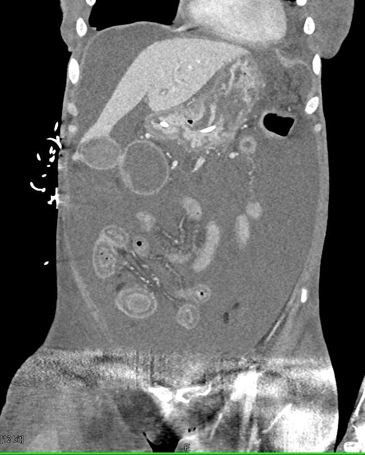 Ischemic Bowel with Submucosal Edema and Ascites - CTisus CT Scan