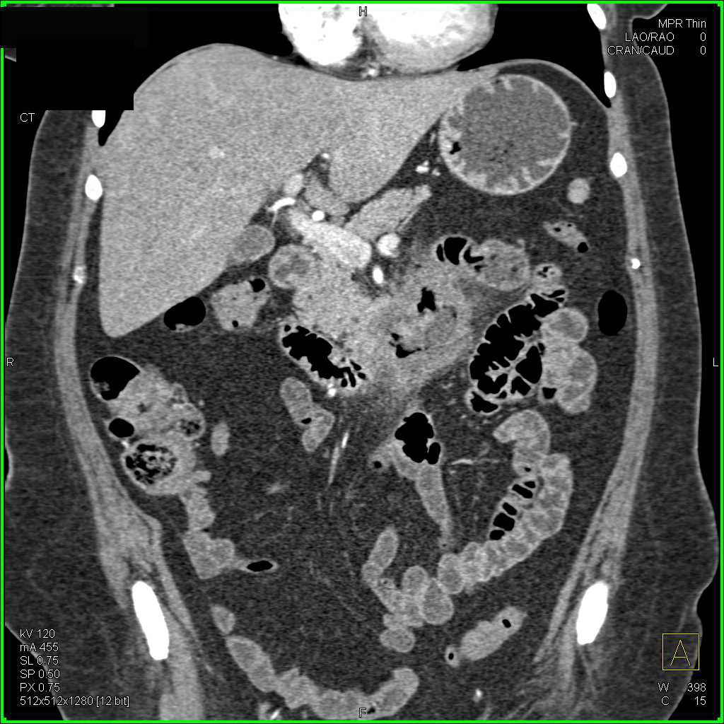 Adenocarcinoma of the Duodenum Near the Ligament of Trietz - CTisus CT Scan