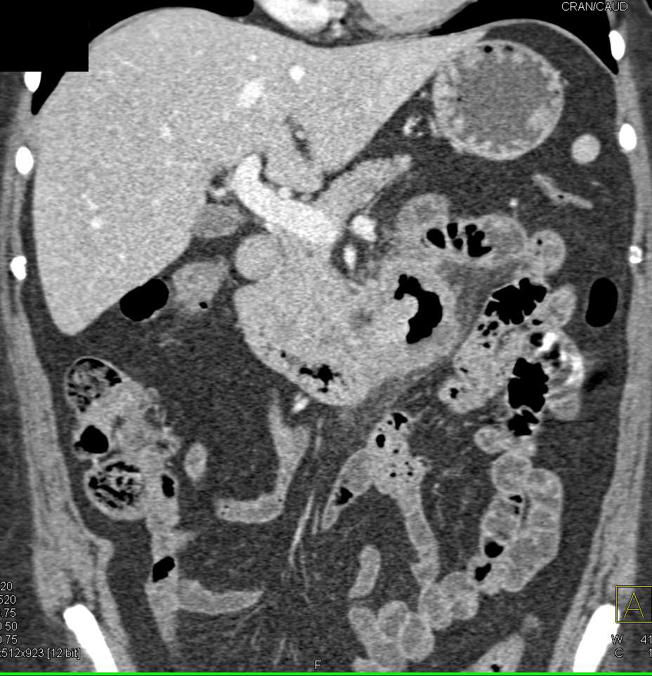 Adenocarcinoma of the Duodenum Near the Ligament of Trietz - CTisus CT Scan