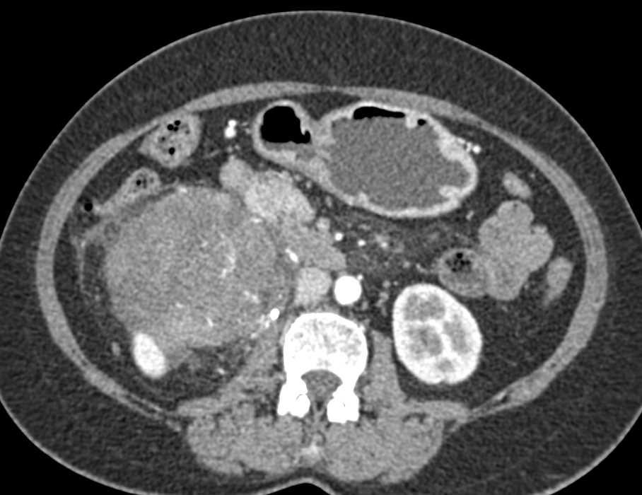 Vascular Small Bowel GIST Tumor - CTisus CT Scan