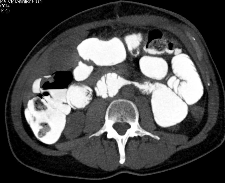 3D VRT Version of a Small Bowel Series with Stricture Near Ligament of Trietz - CTisus CT Scan