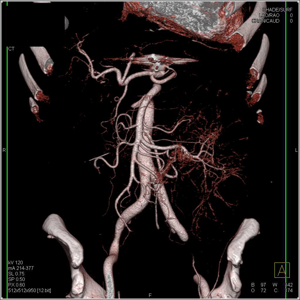 Small Bowel Obstruction due to Adhesions - CTisus CT Scan