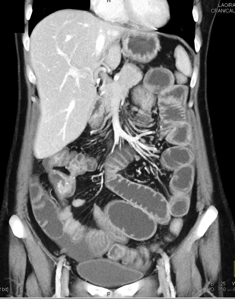 Small Bowel Obstruction (SBO) with Stricture on the Terminal Ileum in a Crohn's Patient - CTisus CT Scan