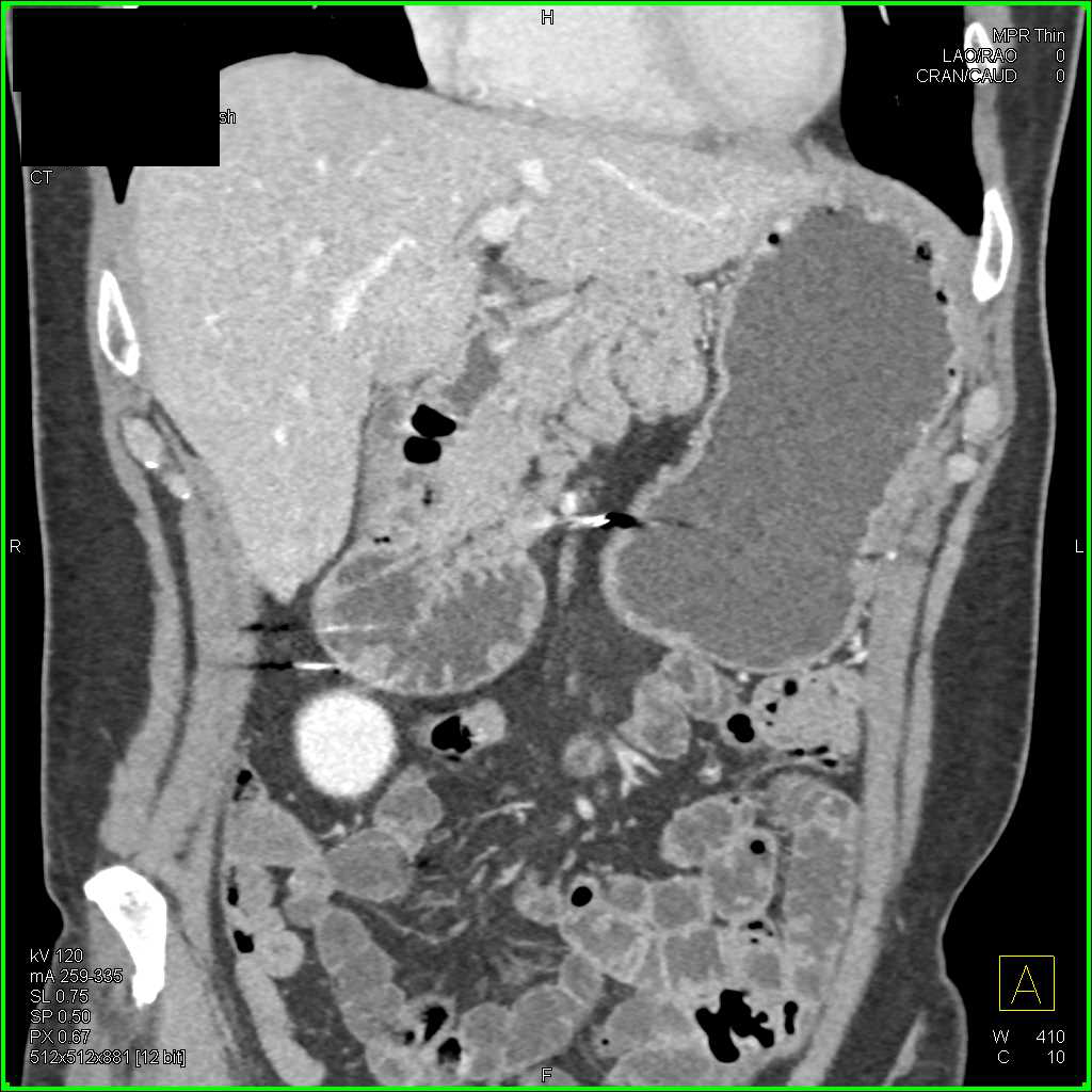 Small Duodenal Polyps - CTisus CT Scan