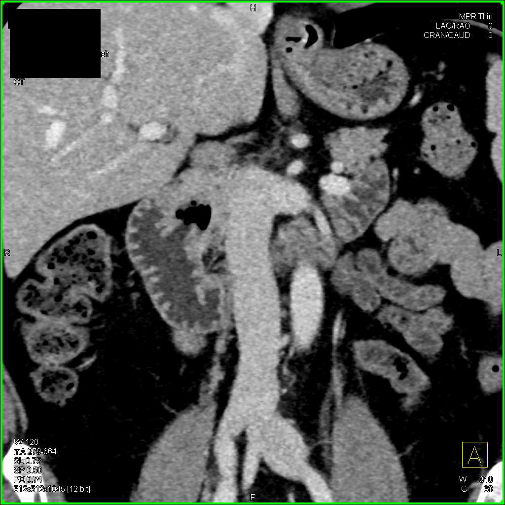 Duodenal Diverticulum in 3D - CTisus CT Scan