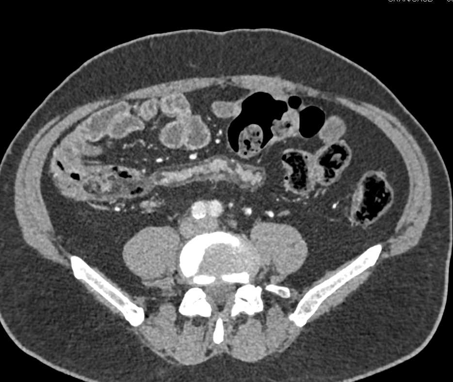 Crohn's Disease with Halo in Small Bowel - CTisus CT Scan