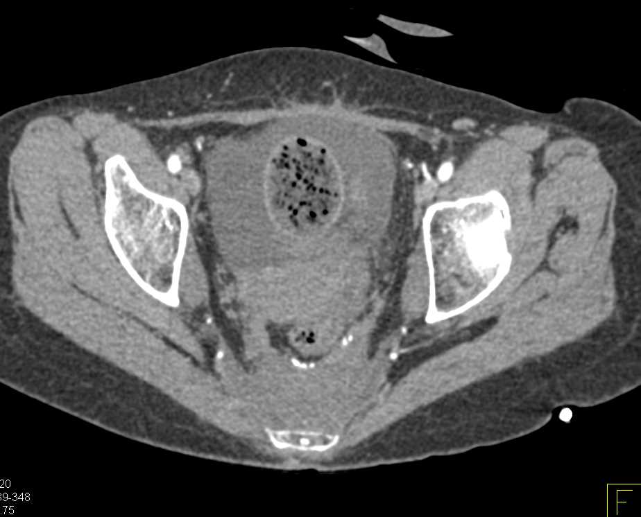 Small Bowel Obstruction (SBO) with Feces Sign and Recurrent Colon Cancer Obstruction - CTisus CT Scan