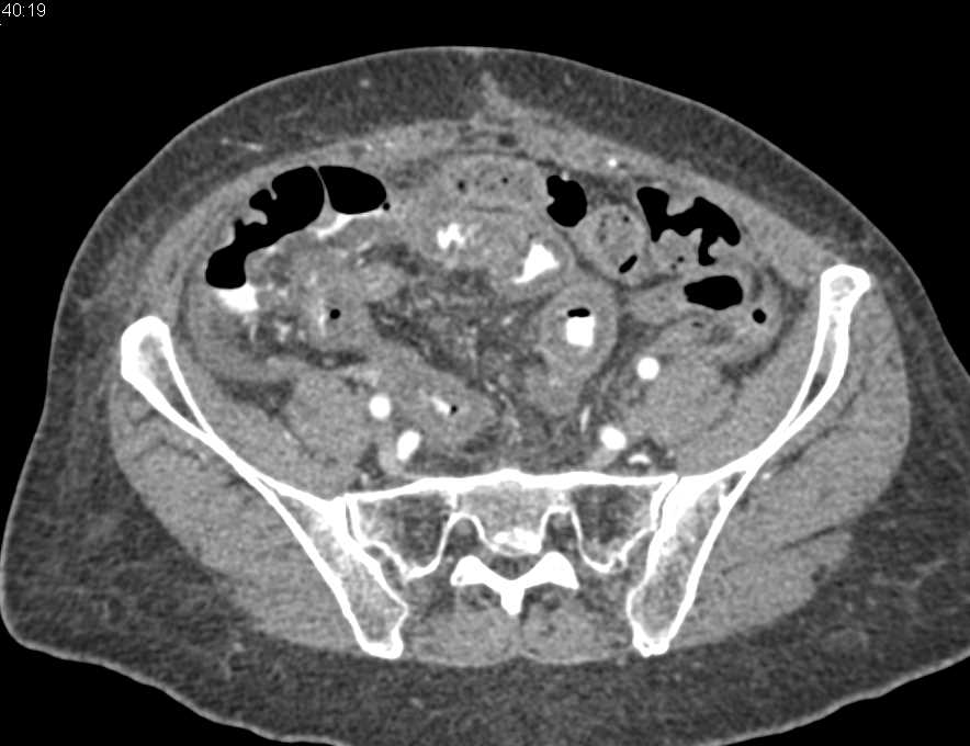 Radiation Enteritis - CTisus CT Scan