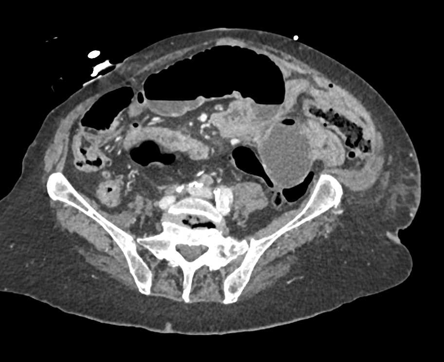 Small Bowel Obstruction (SBO) with Dilated Stomach Also Seen - CTisus CT Scan
