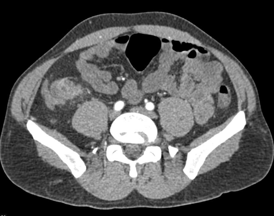 Crohn's Disease ileum and Cecum with Stricture - CTisus CT Scan