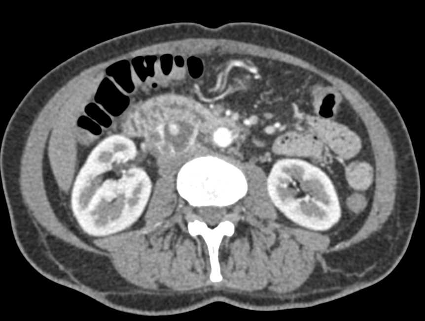 Duodenal GIST Tumor Looks like a Pancreatic Neuroendocrine Tumor (PNET) of the Pancreas - CTisus CT Scan