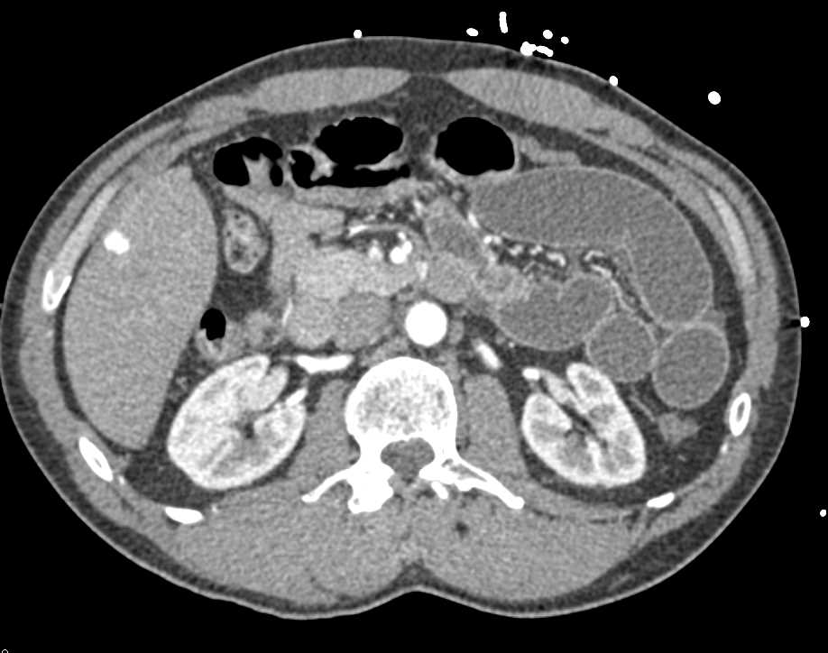 Small Bowel Obstruction due to Adhesions - CTisus CT Scan