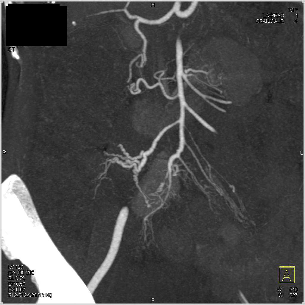 Vasculitis Especially Superior Mesenteric Artery (SMA) Branches Are Involved - CTisus CT Scan