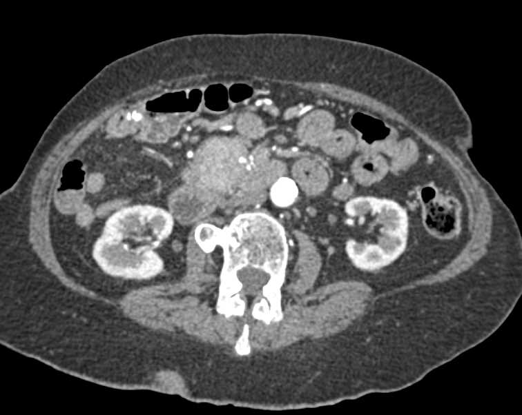 Carcinoid Tumor Root of Mesentery Simulates a Pancreatic Adenocarcinoma. See SMV Cutoff - CTisus CT Scan
