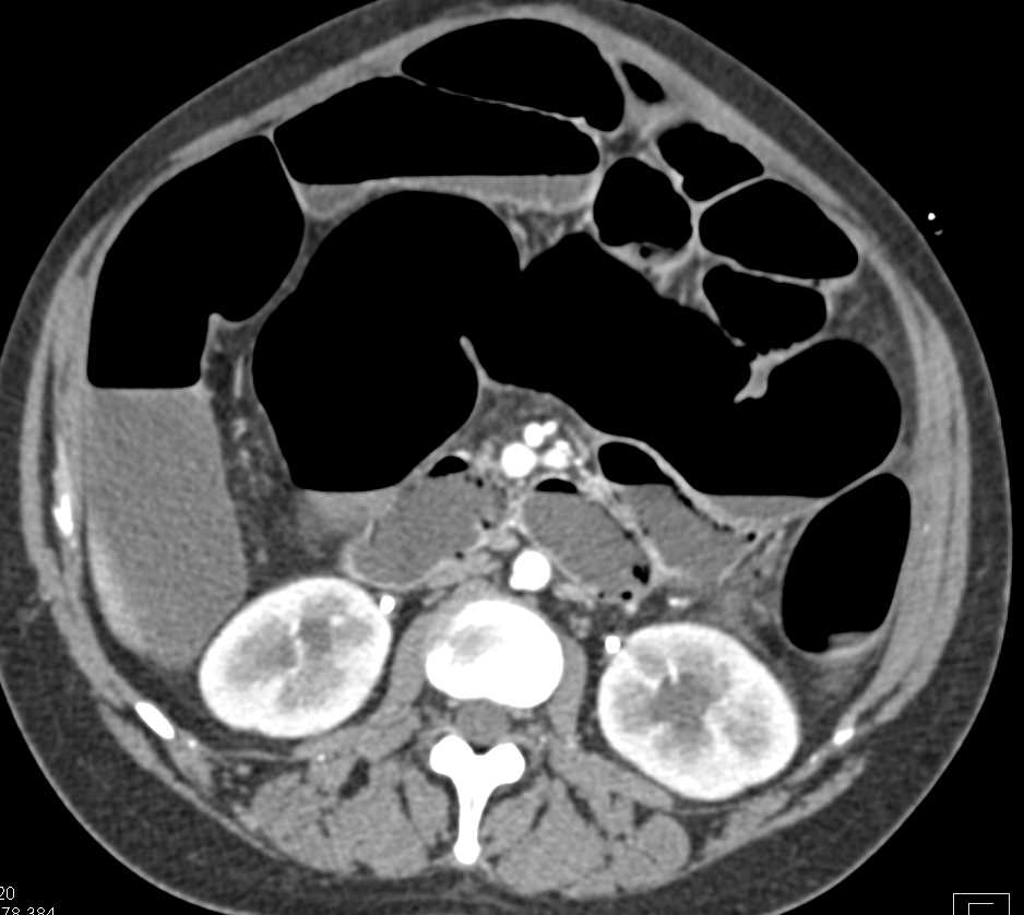 Pneumatosis with Ischemic Bowel - CTisus CT Scan