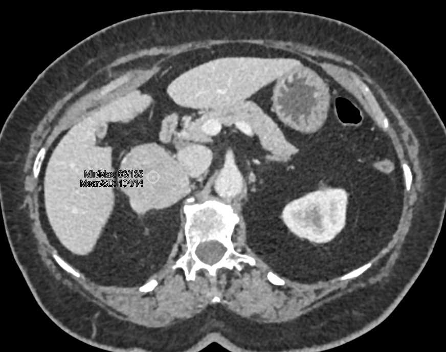 Mesenteric Mass Near Root of Mesentery - CTisus CT Scan