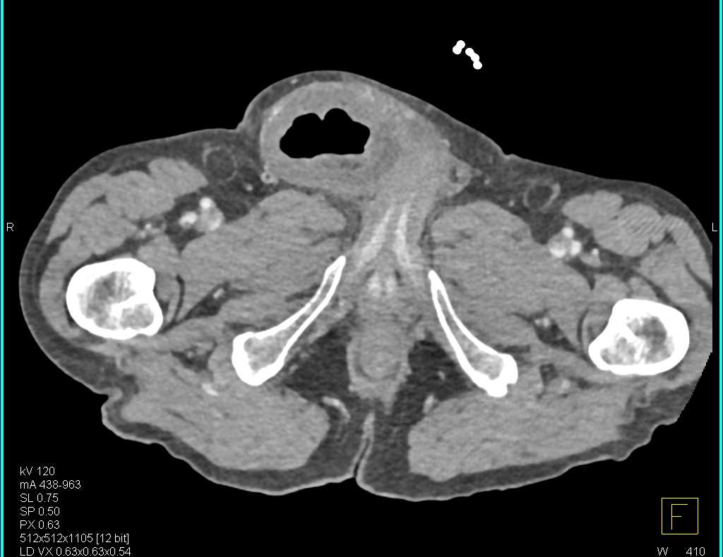Small Bowel Obstruction (SBO) due to Small Bowel into a Incarcerated Inguinal Hernia - CTisus CT Scan