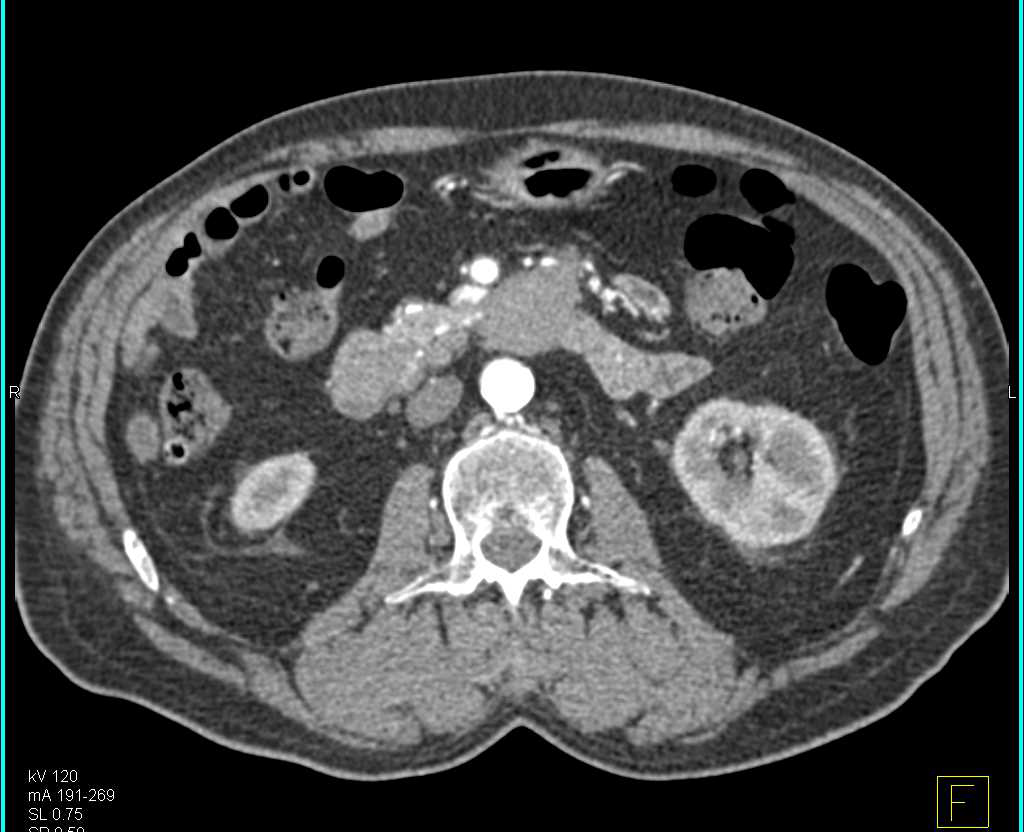 Duodenal Carcinoma in the 3rd and 4th Portion of the Duodenum - CTisus CT Scan