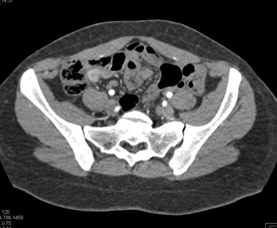 Ileal Carcinoid Tumor - CTisus CT Scan