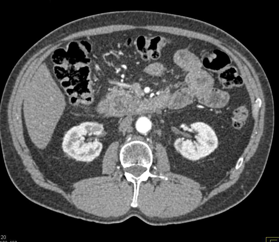 Duodenal Adenocarcinoma - CTisus CT Scan