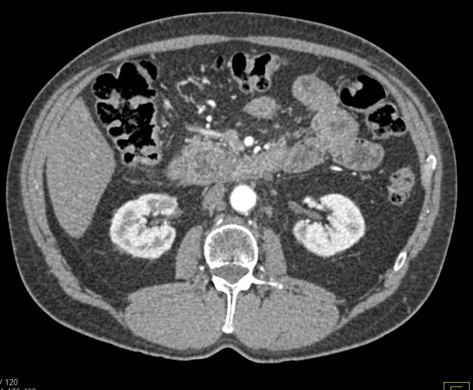 Duodenal Adenocarcinoma - CTisus CT Scan