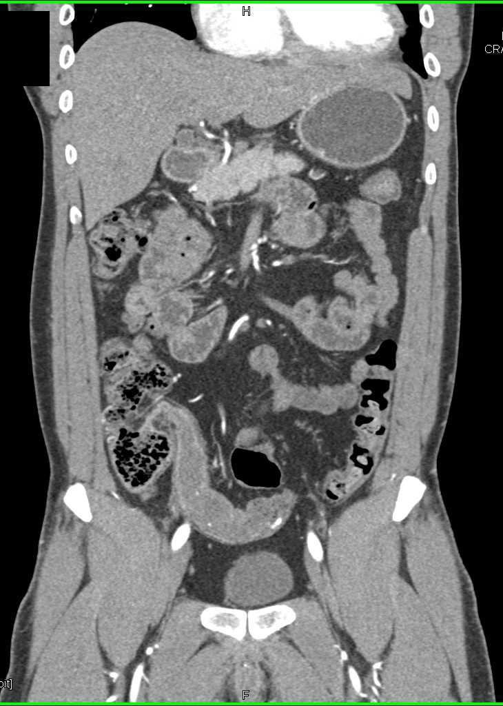 Crohn's Disease with Stricture in Distal Ileum - CTisus CT Scan