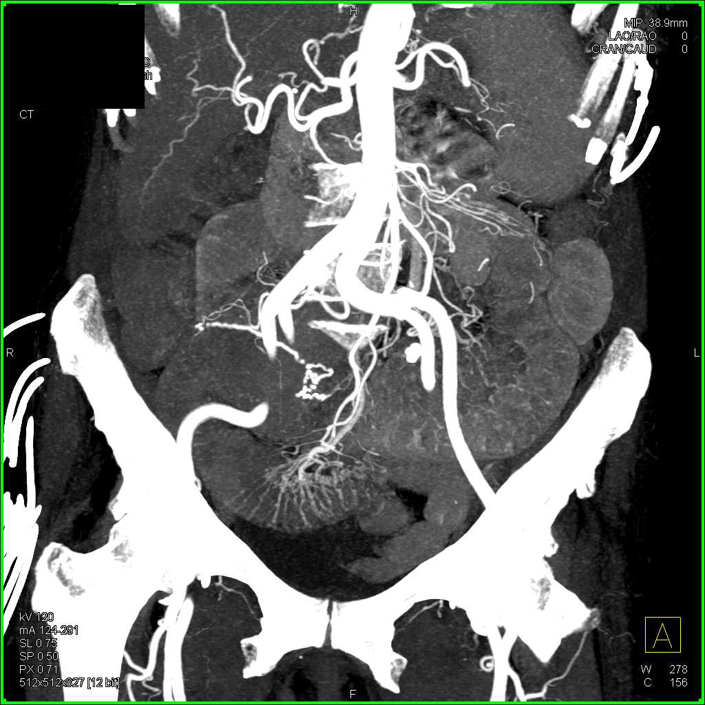 Inflamed Ischemic Small Bowel Loop - CTisus CT Scan
