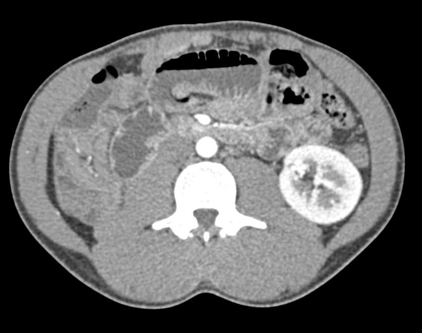 Small Bowel Obstruction due to Metastatic Renal Cell Carcinoma - CTisus CT Scan