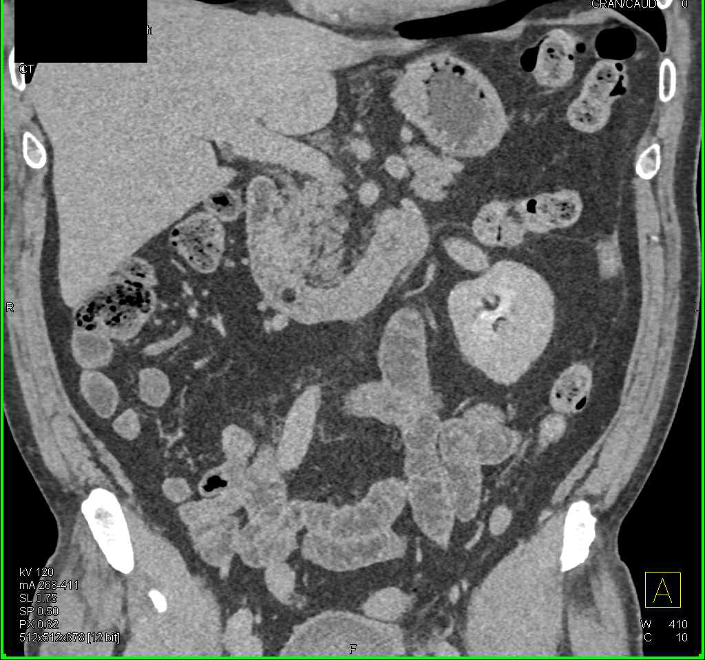 Lipoma in the Duodenum - CTisus CT Scan