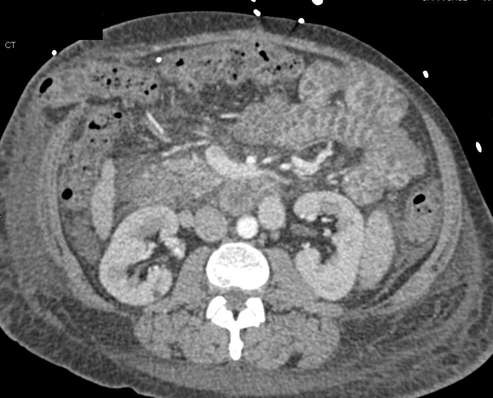 Sprue with Dilated Proximal Small Bowel - CTisus CT Scan
