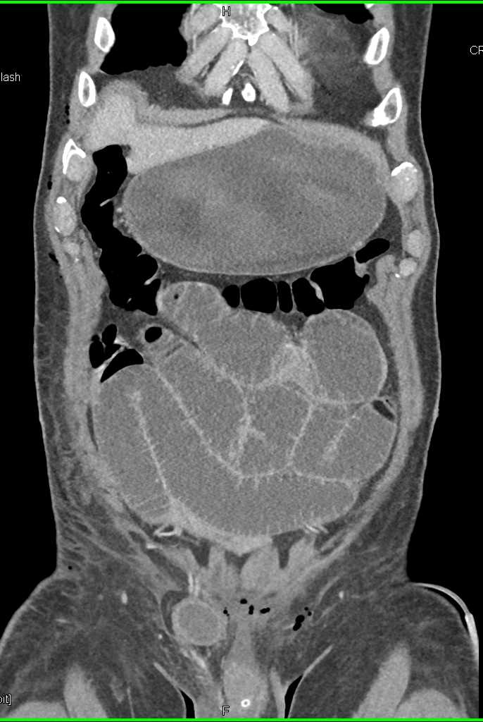Small Bowel Obstruction due to a Distal Hernia in RLQ - CTisus CT Scan