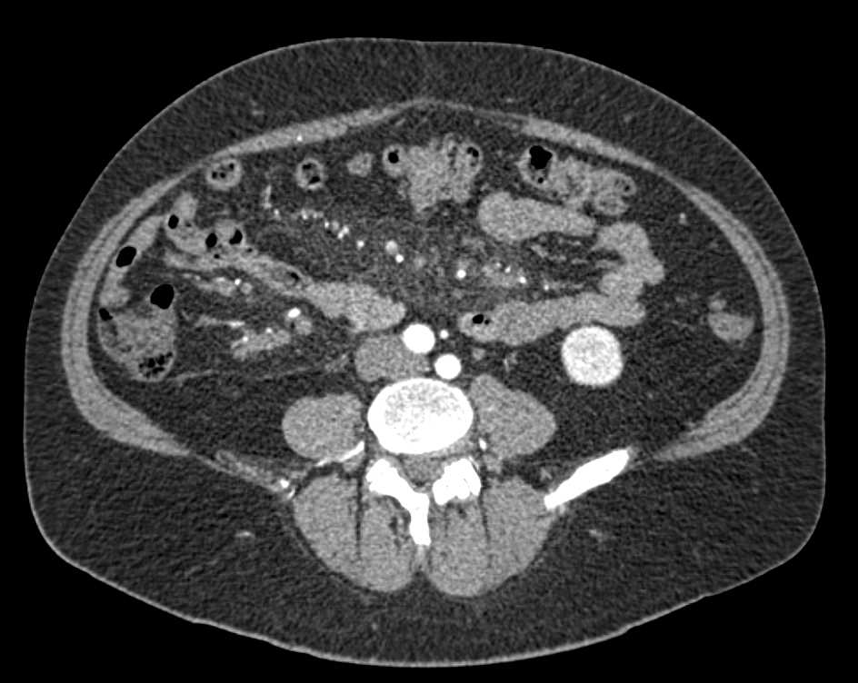 Carcinoid Tumor Root of Mesentery with Misty Mesentery and Vessel Encasement - CTisus CT Scan