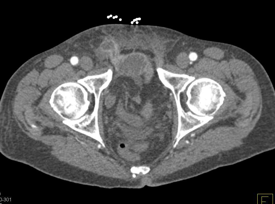 Small Bowel Obstruction (SBO) due to Bowel Trapped in a Inguinal Hernia - CTisus CT Scan
