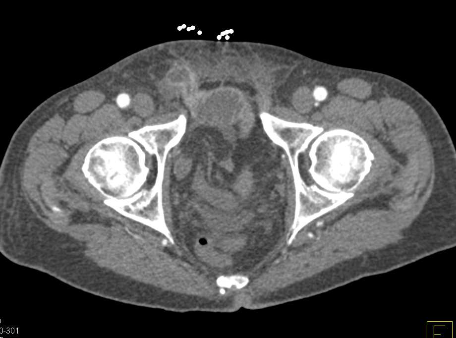 Small Bowel Obstruction (SBO) due to Bowel Trapped in a Inguinal Hernia - CTisus CT Scan