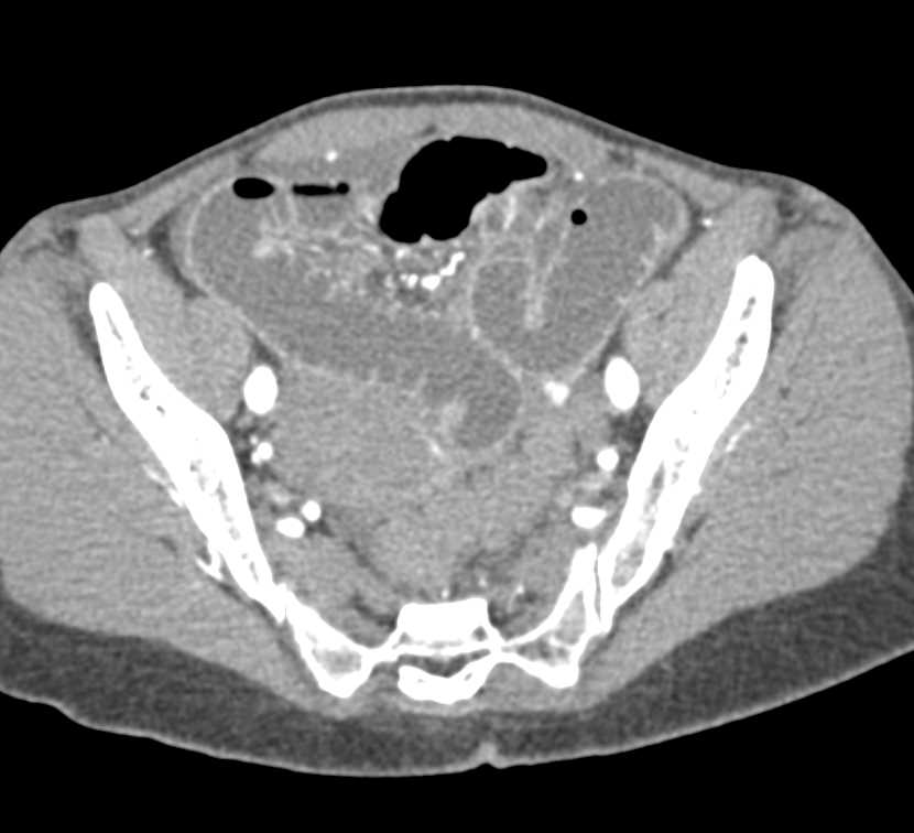 Small Bowel Obstruction due to a Right Inguinal Hernia - CTisus CT Scan