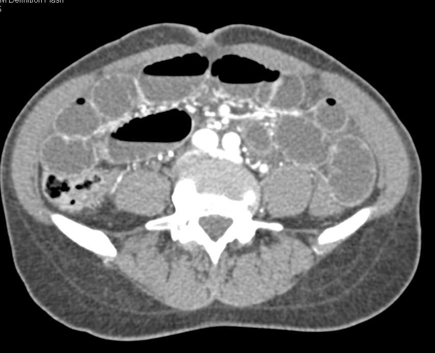 Small Bowel Obstruction due to an Incarcerated Right Inguinal Hernia - CTisus CT Scan