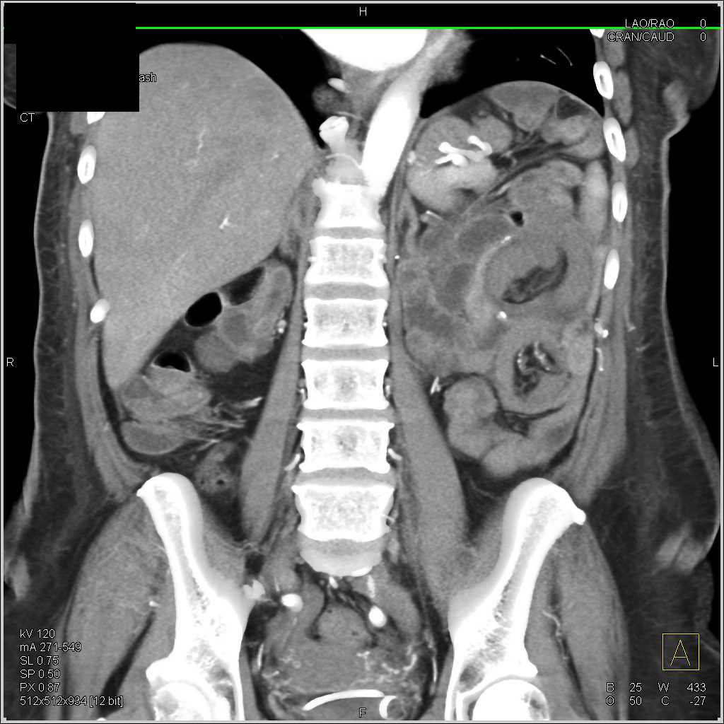 Multiple Small Bowel Intussusceptions - CTisus CT Scan