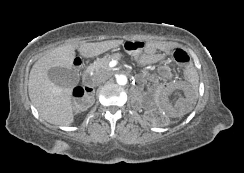 Multiple Small Bowel Intussusceptions Without Tumor in End Stage Renal Disease (ESRD) Patient - CTisus CT Scan